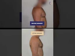 Gynaecomastia Since Starting Body Building 6 Years Prior {Patient 2022-7001} B&A #shorts