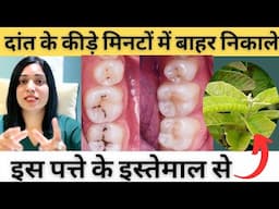 दांतों के कीड़े निकालने का बेस्ट घरेलू उपाय | Home Remedy  For Dental Caries |
