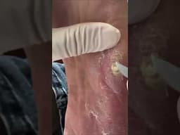 Multi-Layered Foot Corn Gets Peeled Like an Onion! 😳🧅