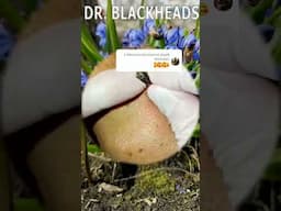 Blackheads Removal | Acne Treatment and Very Satisfying Satisfying Pimple pop #blackheads