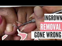 Toenail Trauma Recovery After Nail Avulsion | Deep Sidewalls & Chronic Dry Skin Relief