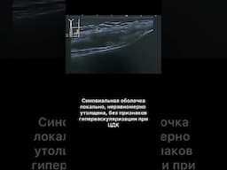 #узи #синовит