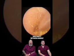Turbo Wiggle Ear Wax Removal! Watch This Big Piece Slide Out 👂🔥