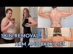 Skin Removal After Losing 100+ Pounds I Brachioplasty & Bra Line Lift