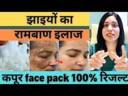 कपूर से  झाइयों को One Week में करे जड़ से ख़त्म | Pigmentation  or Melasma Treatment At Home |