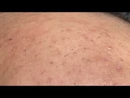 Acne Treatment Huong Da Nang# membership 009 |  | 2023