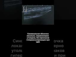 #узи #синовит