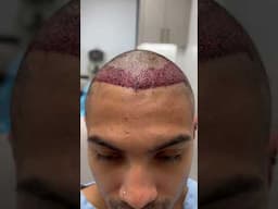 Amazing Natural Hair Transplant Result