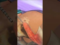 How bone marrow is harvested for donation: Bone marrow harvesting 3d animation