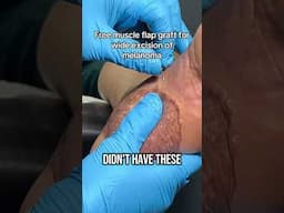 Saving a leg #melanoma #freeflap #graft #footsurgery #limbsalvage #skincancer