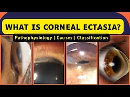 Corneal Ectasia | Pathophysiology, Classification & Biomechanics Made Easy