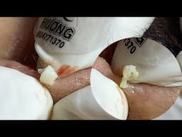 Acne Treatment Huong Da Nang#733 Have a nice weekend!