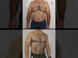 Grade BB 4c Gynaecomastia: Post Weight Loss and Prior Gynaecomastia {Patient 2021-14001} B&A #shorts