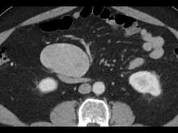 Small bowel carcinoid