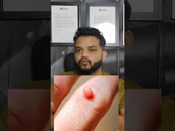 मस्सों का इलाज | Warts Treatment Shorts #shorts #gyanear