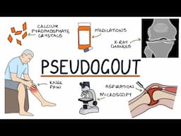 Understanding Pseudogout