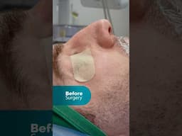 Live from the Operating Room: Rhinoplasty surgery