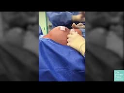 Breast Augmentation Procedure | What happens to a Nipple Piercing during surgery?