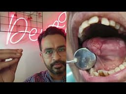 WHITE LESIONS ON TONGUE
