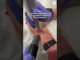 Bye ex tattoo👋 #removery #tattooremoval