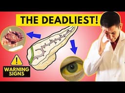 Warning! Pancreatic Cancer: Early Symptoms and Diagnosis [Recognize Them ASAP]