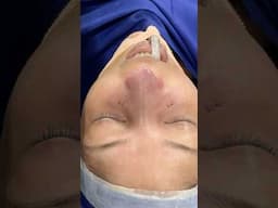 Best nose job plastic cosmetic surgery on India