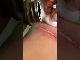 Diabetes Alert 5 Skin Signs You Shouldn’t Ignore #shorts
