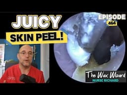 JUICY SKIN PEEL! Episode 464 (and buddy's back!)