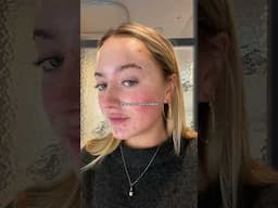 episode two of “pages from this chapter” 📝 #acne #skinjourney #adultacne #twenties #girlhood