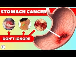 Top 10 Warning Signs of Stomach Cancer You Should NEVER Ignore