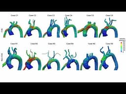 Can blood flow patterns help reveal stroke risk in people with a common heart failure treatment?