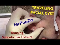See the facial cyst that blooms like a flower.See the hidden running subcuticular suture.