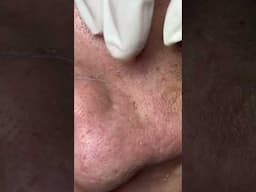 Linhmydangspa (14/5/2025)-45 minutes for her nose area, but my phone ran out of storage