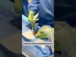 Real relief. Real results.💪💉✨ #uterinefibroidembolization #ufe #painrelief #minimallyinvasive