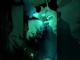 Successful Sinus Lifting Procedure at Fusion Dental Implant Center!
