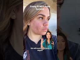 I love seeing real results from real people using my SLMD Acne System! ❤️
