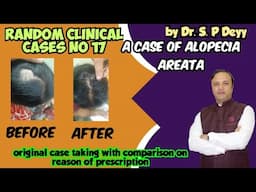 A Case of Alopecia areata | एलोपीसिया अरिएटा का एक कम्पलीट क्युर केस
