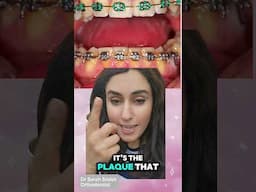 Do Braces Make Your Teeth Yellow?