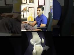 Is Internal Bracing Necessary in Every ACL Surgery? || Internal Brace Surgery