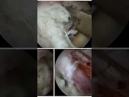 Spine Endoscopy Surgery : How is it done स्पाइन एंडोस्कोपी सर्जरी: यह कैसे की जाती है? #pune #doctor