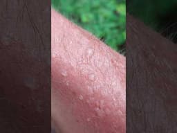 🔥 Sunburn Disaster! -- Blistering Skin After Days on the Road