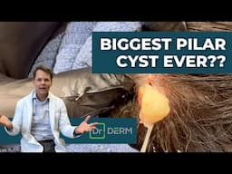 BIGGEST Pilar Cyst Ever?? | Dr. Derm