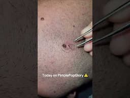 1 Minute Of Top ASMR Pimple Popping Video №99