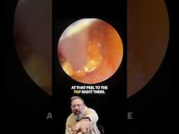 4CM Skin & EAR Wax Peel! Cotton Bud Surprise 👂😳