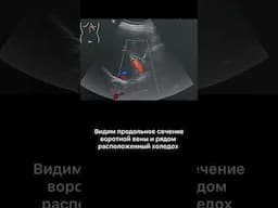 #узи #холецистэктомия