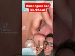 Humongous EAR BLACKHEAD REMOVAL - So Satisfying #shorts