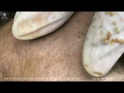Big Cystic Acne Blackheads Extraction Blackheads & Milia, Whiteheads Removal Pimple Popping