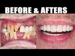 Dental Implants BEFORE & AFTER! Results for All-On-4, Single Tooth (Front & Back) & Bridges