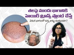 చాలామంది అడిగే ప్రశ్న - If I Transplant Hair in The Front, What Happens to the Back ? || THF