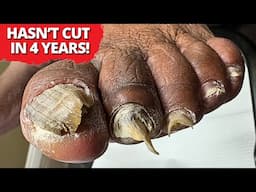 4 YEARS of Toenail Growth—You Have to See This! 😳